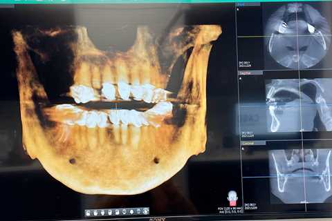 My oral surgery