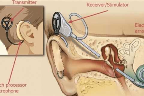 Questions You Need to Ask About Cochlear Implants