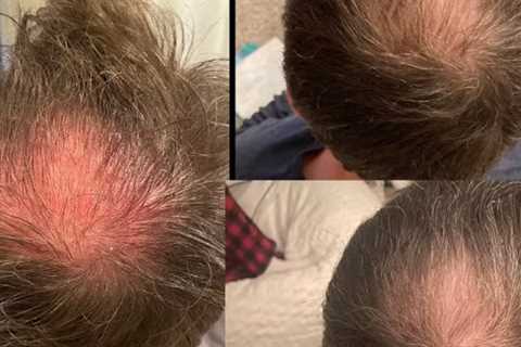 Laser Hair Therapy Havertown, PA · Tuesday, May 13 📸