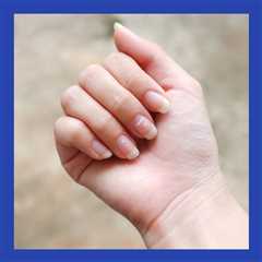 Clinically Speaking: Questions and Answers About Graves’ disease